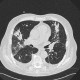 Bronchoinvasive aspergillosis, aspergillosis: CT - Computed tomography